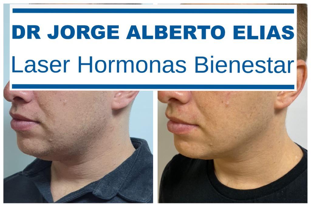 Antes y después tratamiento de arrugas